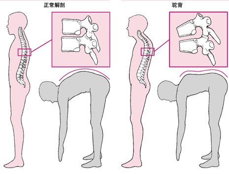 成都京研强直性脊柱炎研究院